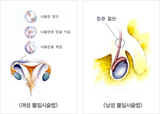 여성,남성 불임시술법 이미지