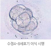 수정4~8세포기 이식 시행